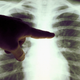 A doctor pointing to the lung X-ray of a cigarette smoker